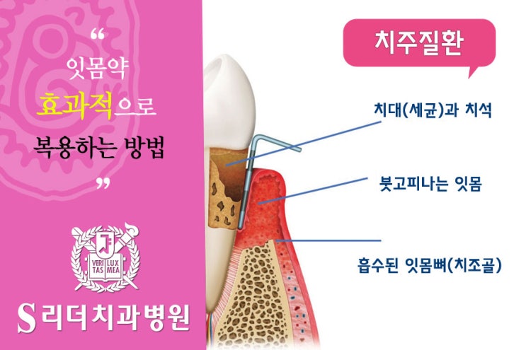광진구치과 잇몸약을 효과적으로 복용하는 방법 관련 이미지 4