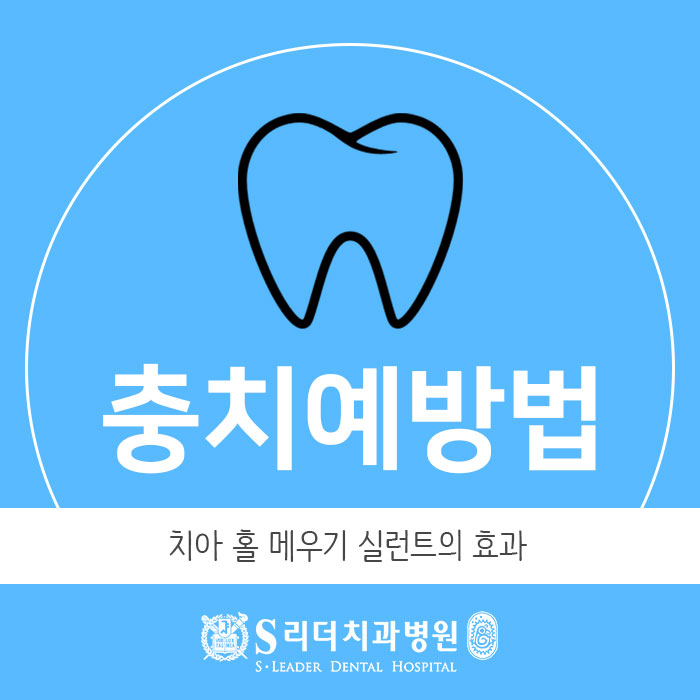 충치예방법 치아홈메우기 얼마나 효과있을까? 관련 이미지 1