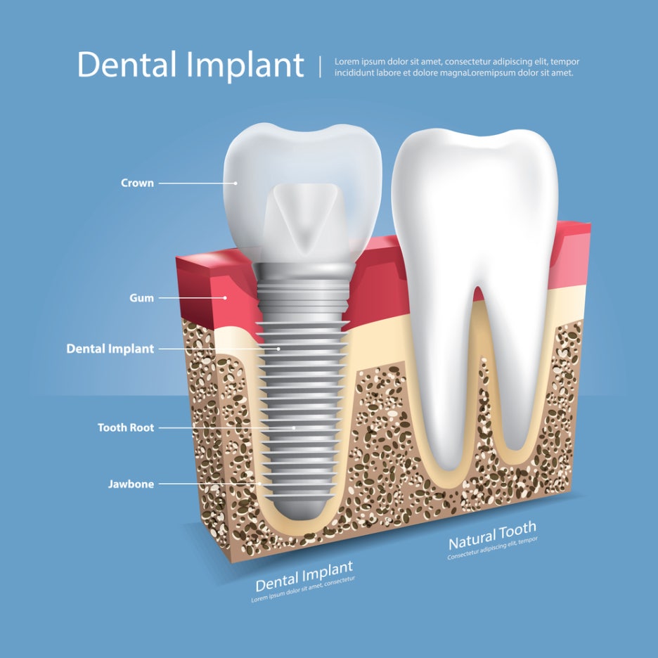 Three Smart Ways to Choose a Dental Clinic for Implant Treatment in Seoul image 4