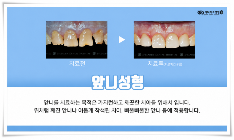 앞니 라인 하나로 달라지는 첫인상, 노원역치과에서 알려드립니다 관련 이미지 3