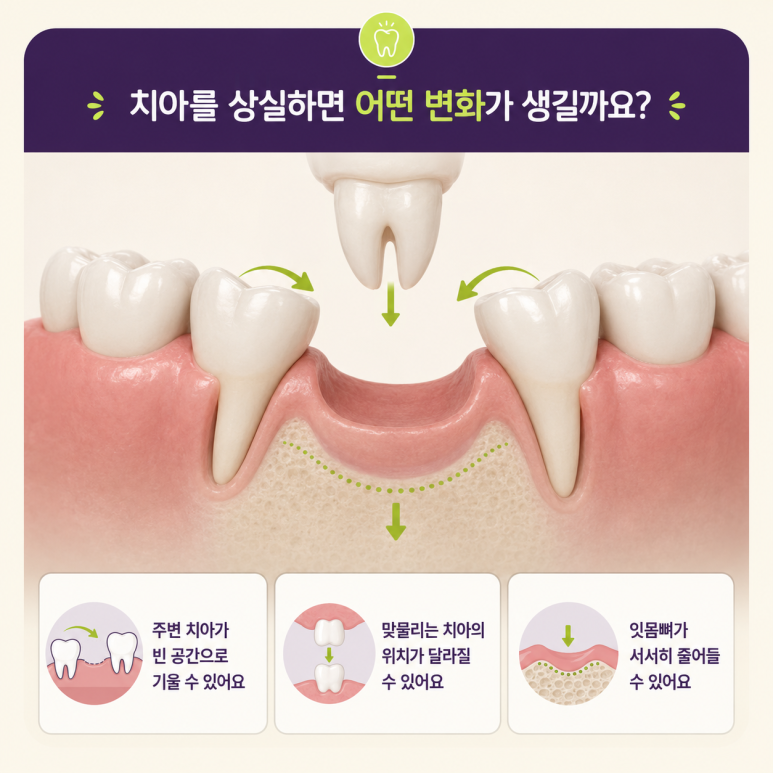 성수동임플란트, 치아 상실 후 임플란트·브릿지·틀니 어떤 차이가 있을까? 관련 이미지 2
