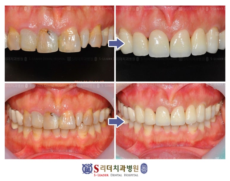 Konkuk Dental Hospital, Is the Pain Really Severe After Implant Bone Grafting? image 5