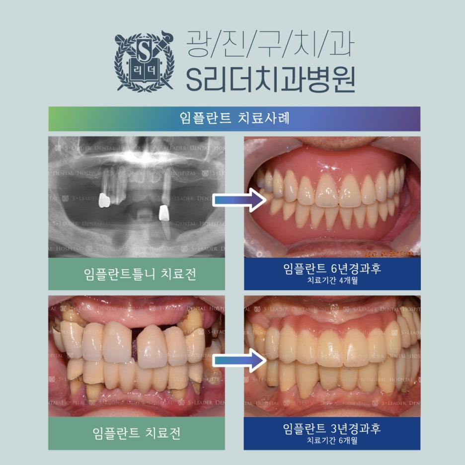 자양동 임플란트치과 찾기 전 알아두면 좋은 3가지는? 관련 이미지 2