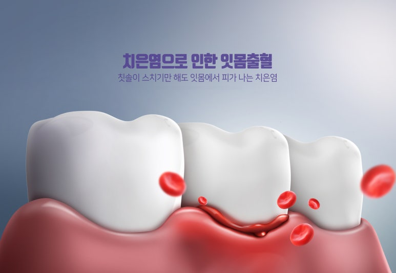 Songjeong-dong Dental Clinic: From the Causes of Gum Bleeding to Treatment Methods image 2