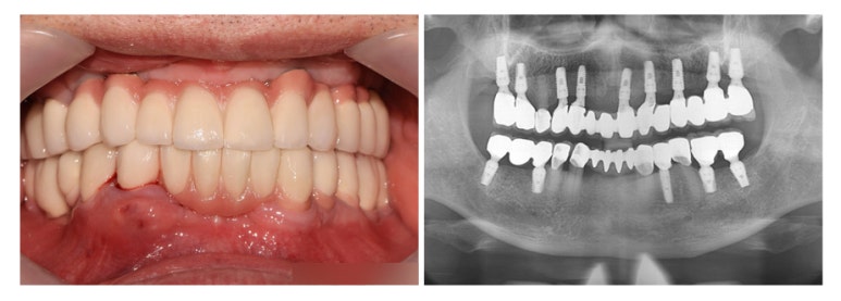 Sanggye-dong Implants: The Same Treatment Cannot Be Right for Everyone image 6