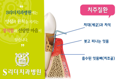 건대입구치과 | 잇몸병은 왜 조용히 진행될까? 초기 신호 체크리스트 10가지 관련 이미지 6