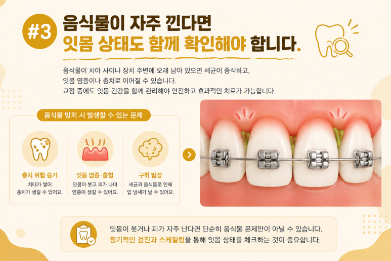 Mangu-dong Dental Clinic: Why Food Keeps Getting Stuck Between Your Teeth During Orthodontic Treatment and How to Manage It image 5