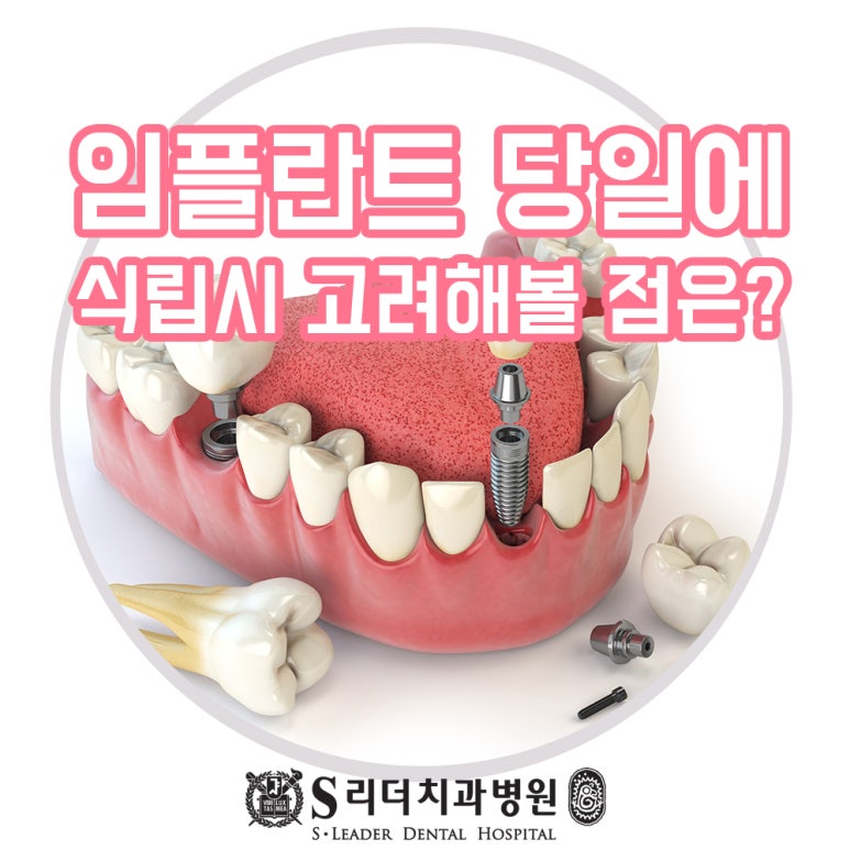 자양동 치과추천 당일임플란트의 양면성에 대해 알고 관련 이미지 1