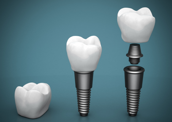 3 Things to Check When Considering Implants at Sagajeong Dental Clinic image 8