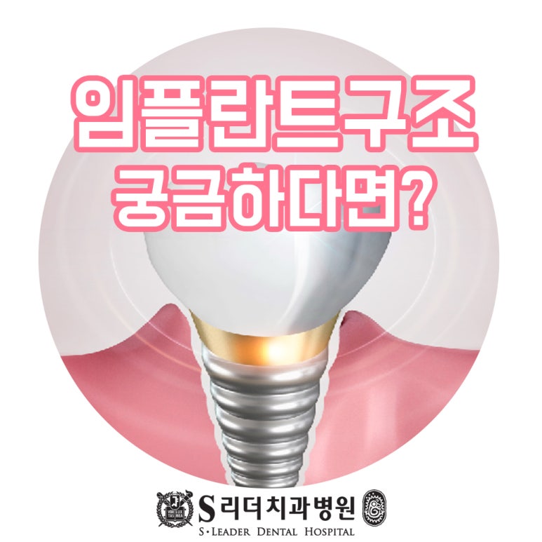 건대치과 임플란트구조 이해하면 관리하기에 도움이 되는 관련 이미지 1