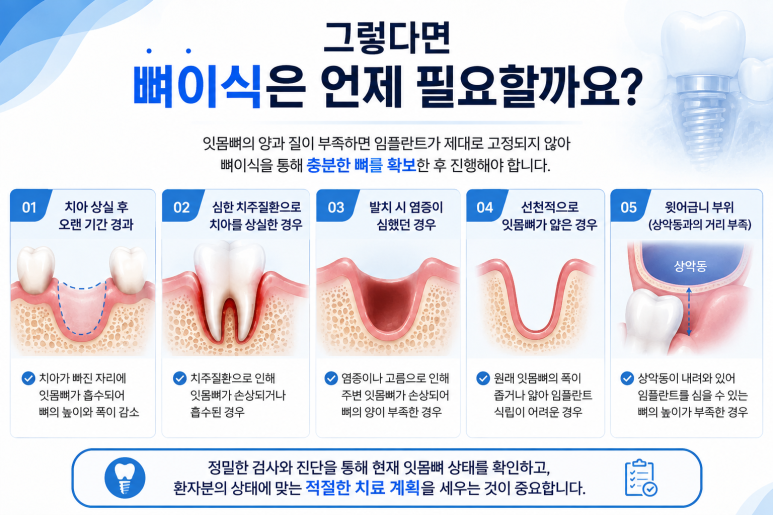 광장동치과, 뼈이식 꼭 해야 하나요? 임플란트 뼈이식이 필요한 경우 관련 이미지 3