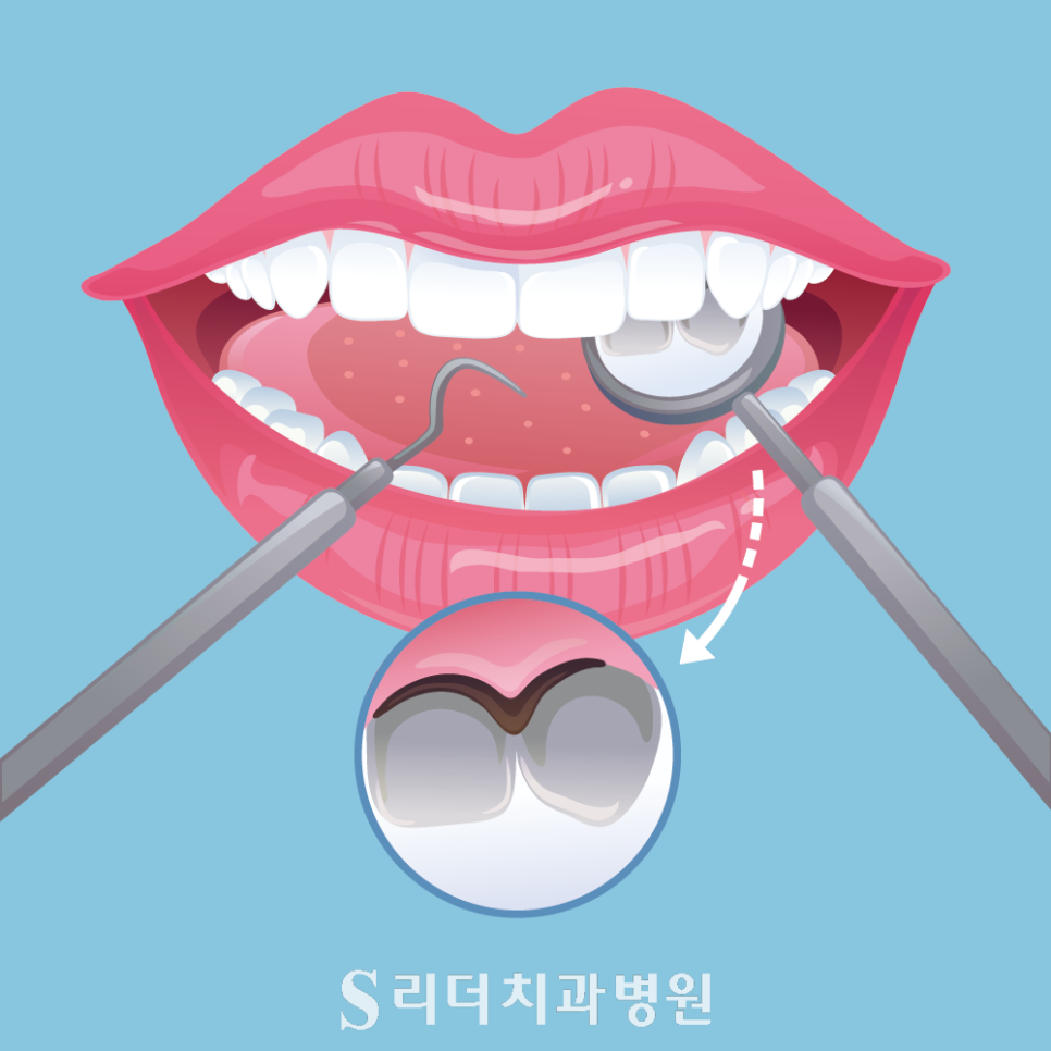 면목동치과 소아청소년 스케일링, 치주질환유병률에 대해 관련 이미지 2
