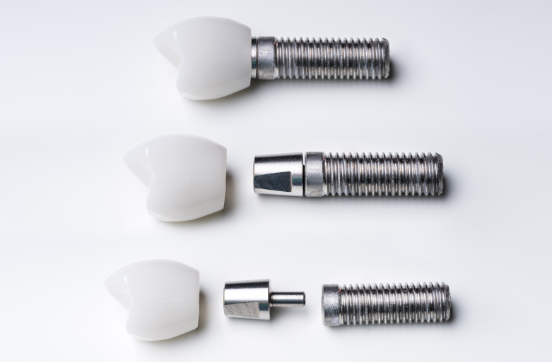 3 Things to Check When Considering Implants at Sagajeong Dental Clinic image 1