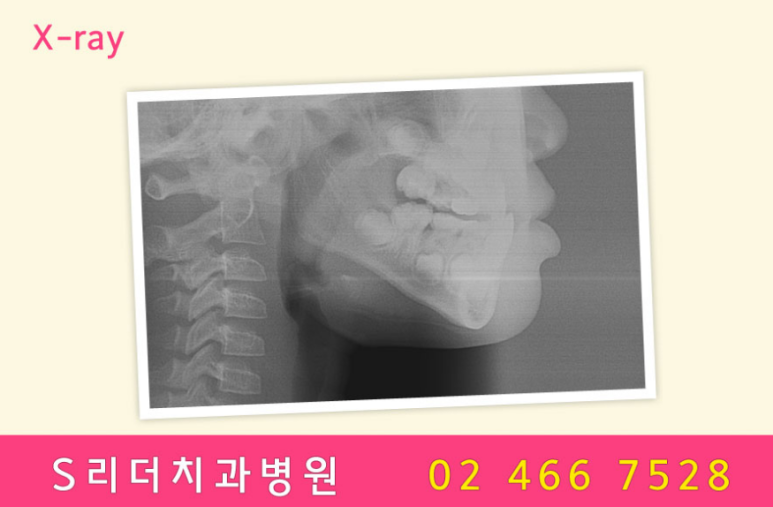 용마산역치과, 덧니 주걱턱 치아교정 개선하기 위한 과정은 관련 이미지 4