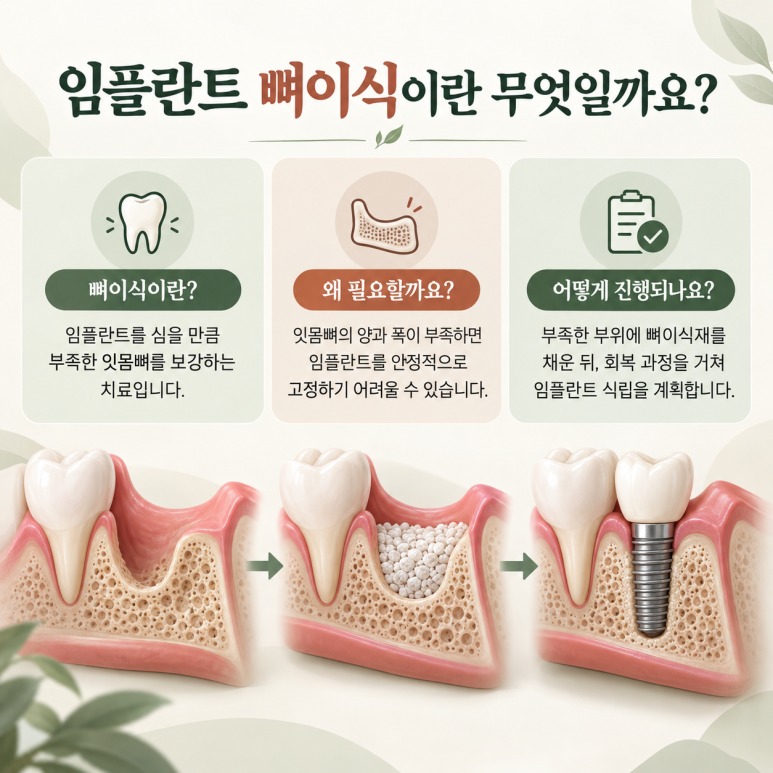 건대입구역치과 임플란트 뼈이식, 꼭 해야 하는 경우는? 관련 이미지 2