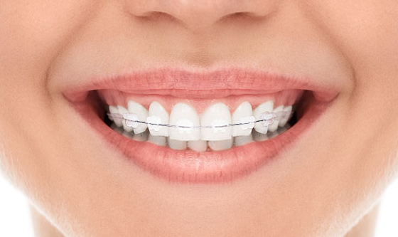 [Seoul Orthodontic Dental Clinic] Everything About Orthodontic Appliances! Features by Type and Selection Guide image 3