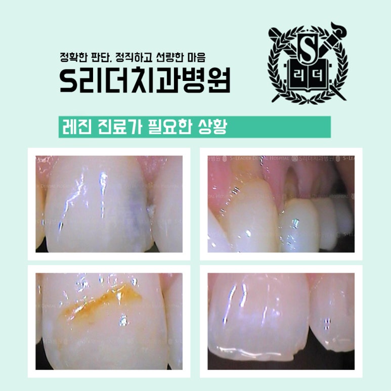 성동구치과 앞니레진수명 관련해 고려해야 할 점은 관련 이미지 2