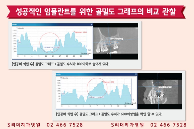 건대치과 성공적인 임플란트를 위한 포인트! 관련 이미지 2