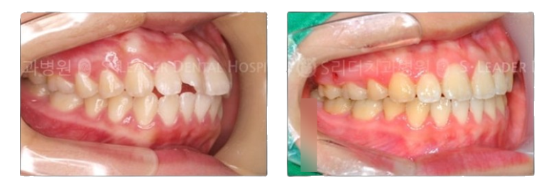 [Seoul Orthodontic Dental Clinic] Everything About Orthodontic Appliances! Features by Type and Selection Guide image 7