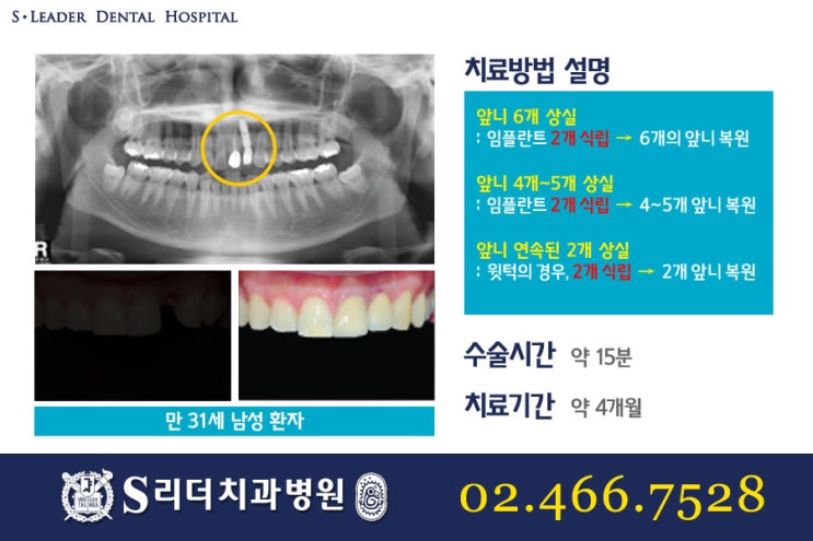 앞니임플란트 몇개를심어요? 관련 이미지 4
