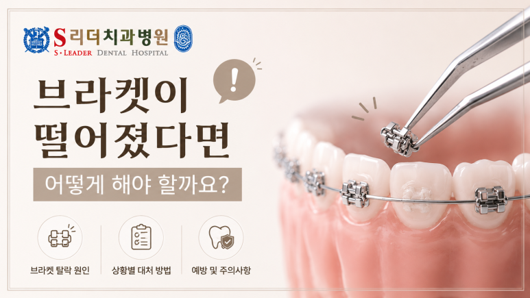 광진구치과|교정 장치가 떨어졌을 때 대처 방법, 그냥 두어도 괜찮을까요? 관련 이미지 3
