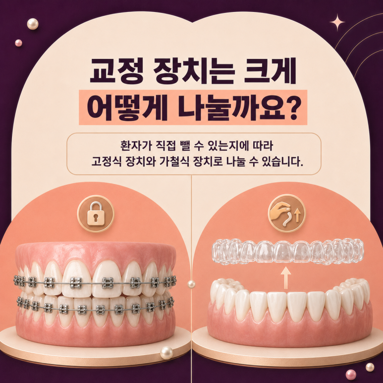 군자치과, 치아교정 장치는 어떤 게 좋을까요? 교정 장치 종류 알아보기 관련 이미지 3