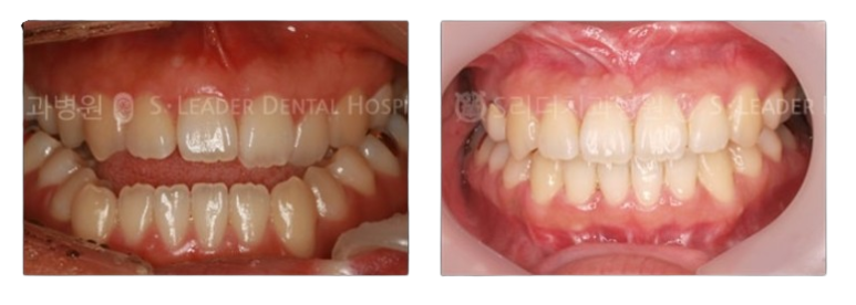 [Mangu-dong Dental Clinic] Cases Requiring Orthodontic Treatment: Protruding Jaw or Crossbite image 6