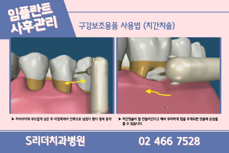 광진구치과 임플란트 단점정리 관련 이미지 16