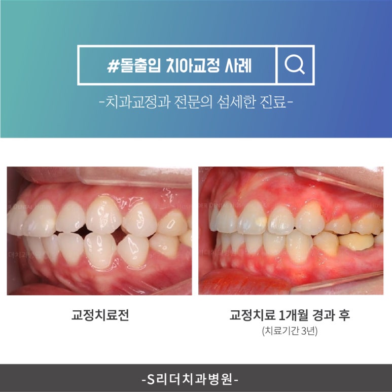 화양동치아교정, 합리적인 비용으로 에스리더치과병원에서 만나보세요! 관련 이미지 4