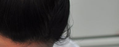구의역치과 치아교정 스크류 꼭 해야할까요? 관련 이미지 6