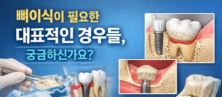 Sanggye-dong Implants | Why Bone Grafting Is Needed When There Is Not Enough Jawbone image 4