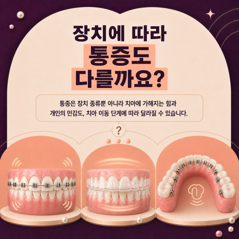 군자치과, 치아교정 장치는 어떤 게 좋을까요? 교정 장치 종류 알아보기 관련 이미지 10