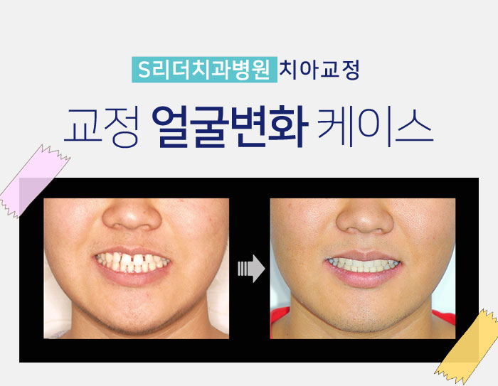 면목동치과 성인앞니교정이 필요한 이유 관련 이미지 17