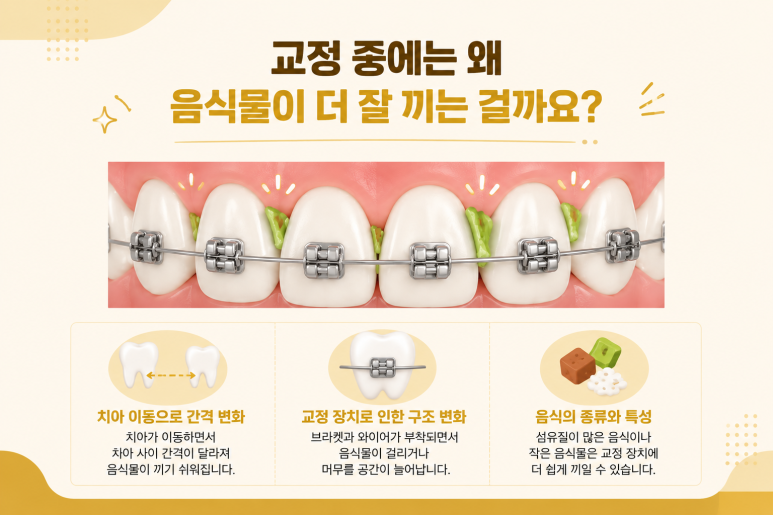 Mangu-dong Dental Clinic: Why Food Keeps Getting Stuck Between Your Teeth During Orthodontic Treatment and How to Manage It image 2