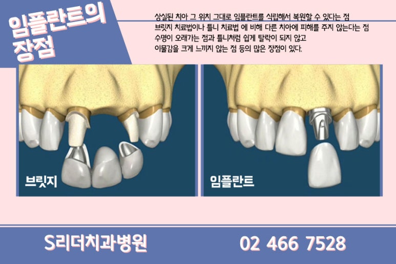 광진구치과 임플란트 단점정리 관련 이미지 13