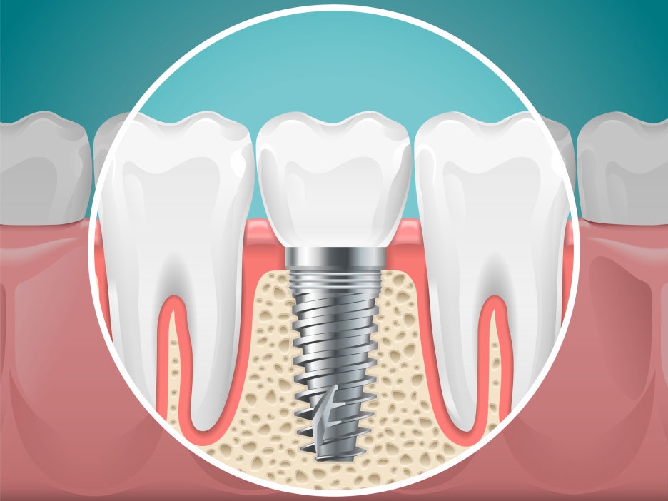 3 Things to Remember Before Getting Implants at Achasan Dental Clinic image 14