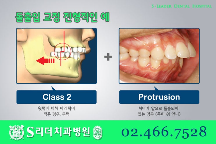 건대교정치과 똑같은 돌출입치아교정이 아니라는 점. 관련 이미지 3
