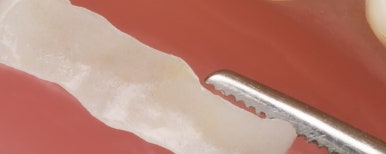 면목역치과 이갈이 하면 안좋은 점, 뭐가 있을까요? 관련 이미지 11