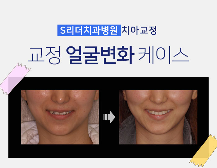 건대입구교정치과 교정얼굴변화 확인해보자 관련 이미지 4
