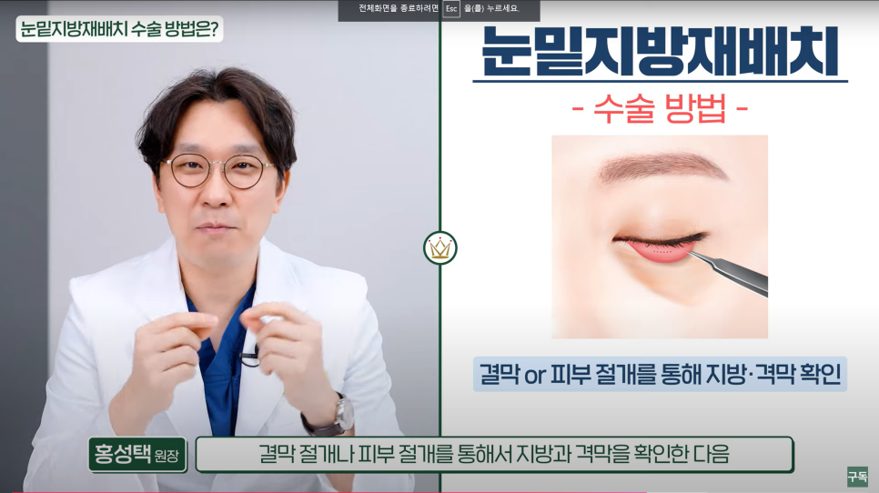 Tired of Hearing That Dark Circles Make You Look Older? Solve It with Just One Surgery image 1
