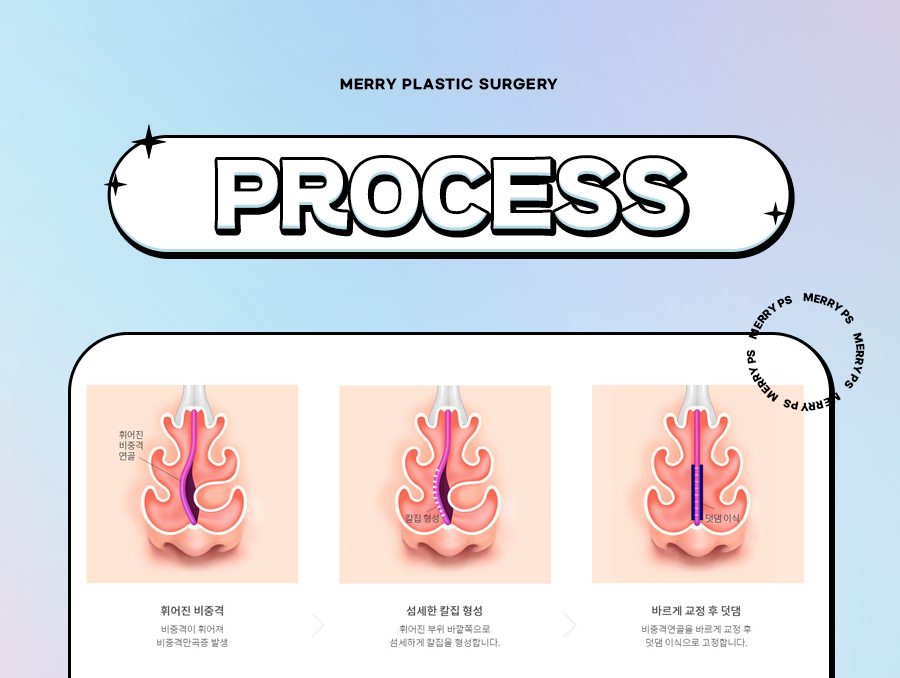 비중격만곡증 기능코로 자연스럽고 숨쉬기 편한코 관련 이미지 5