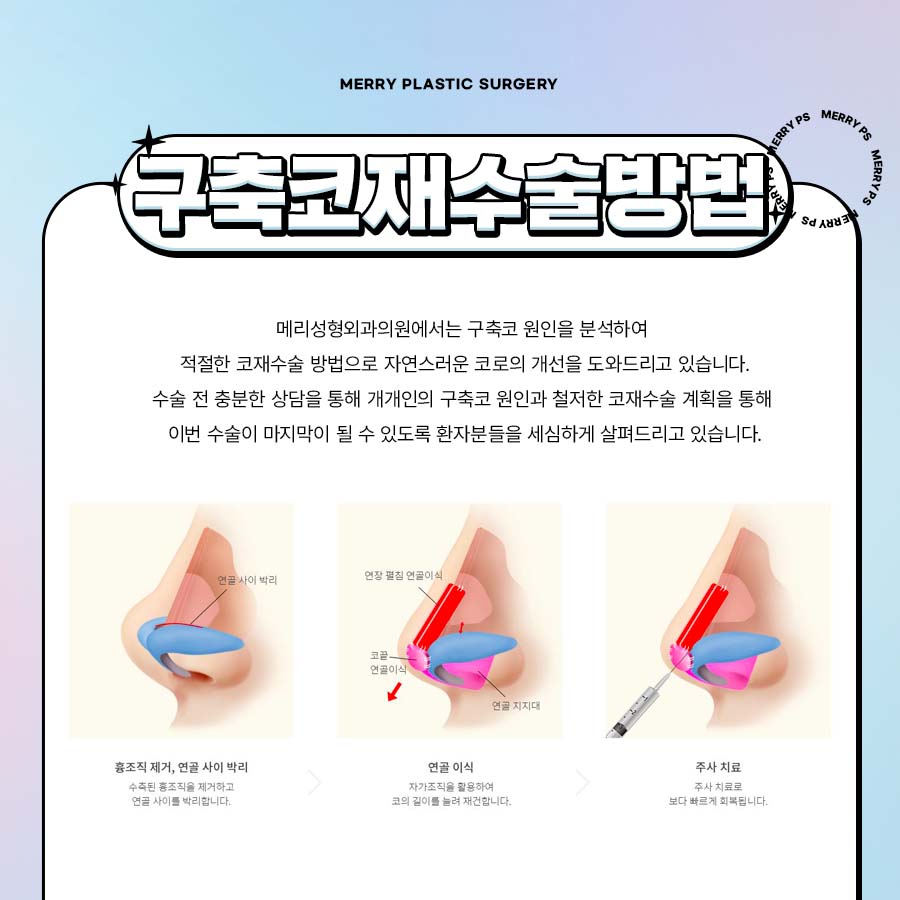 압구정 메리성형외과 구축코 재수술로 다시 자연스럽게 관련 이미지 4