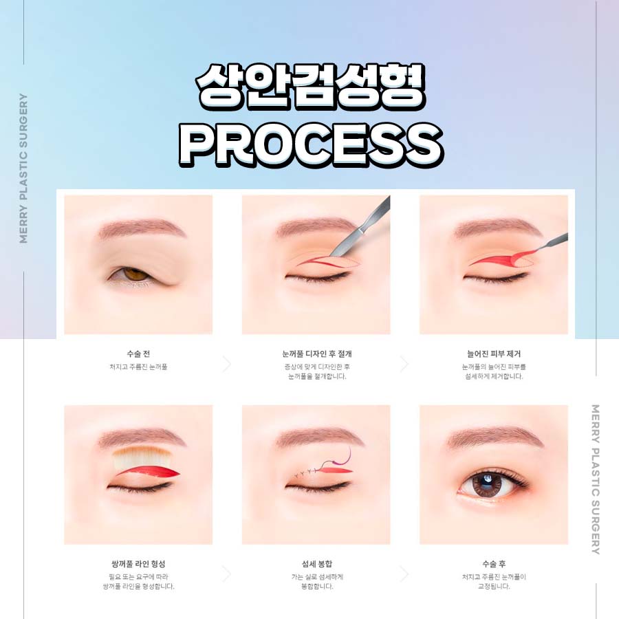 중년눈 상안검수술 효과 중년의 자연스러운 멋 관련 이미지 5