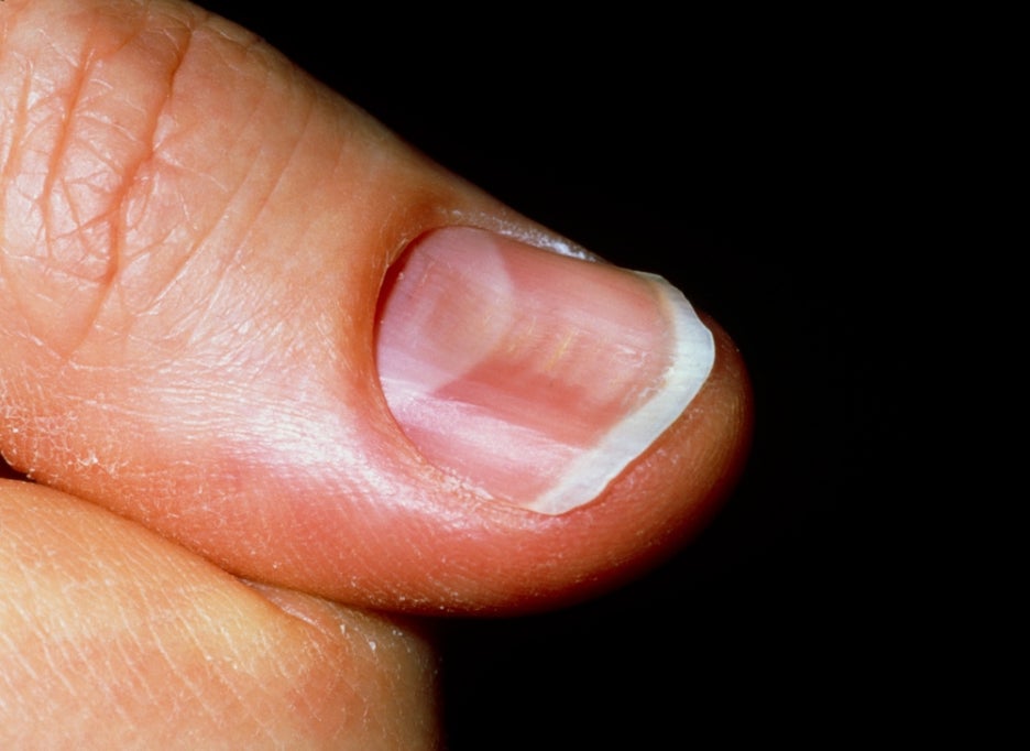 Why Do Black Vertical Lines Appear on Nails? What Health Problems Can Nail Colors Indicate? image 4