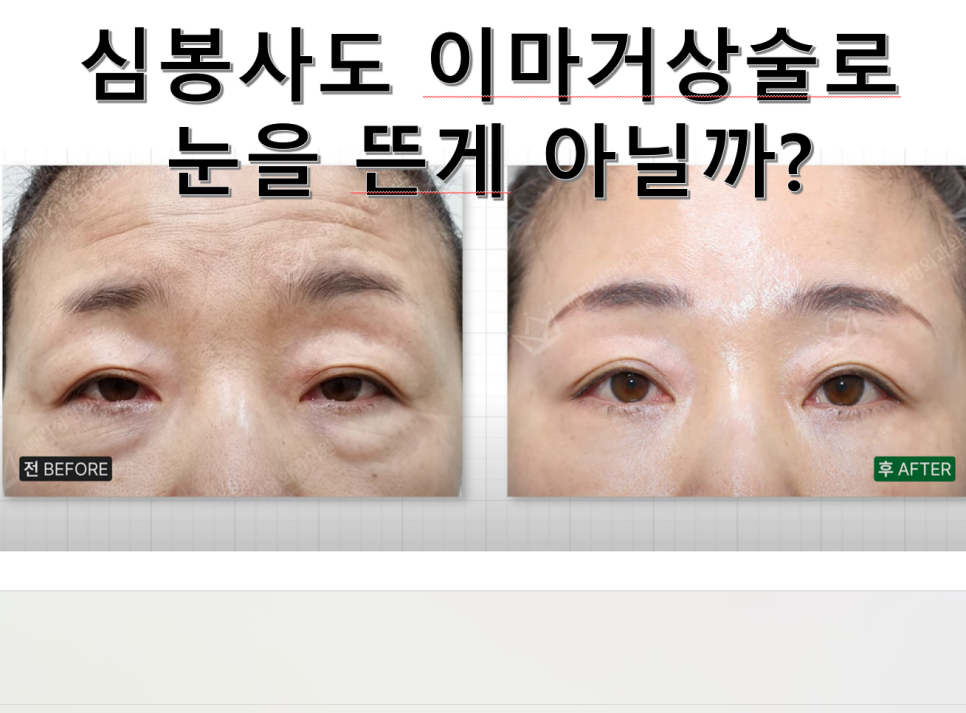 내시경 이마 거상수술을 하면 이마가 넓어질까? 관련 이미지 1