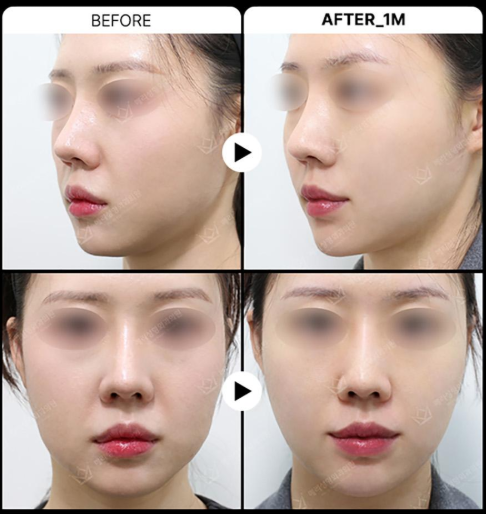 실리프팅 :: 중안면부 탄력/팔자주름 고민? 실리프팅으로 당기고, 유지하세요! 관련 이미지 5