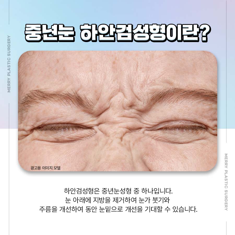 Smooth Bulging Under-Eyes with Lower Blepharoplasty for Middle-Aged Eyes image 2