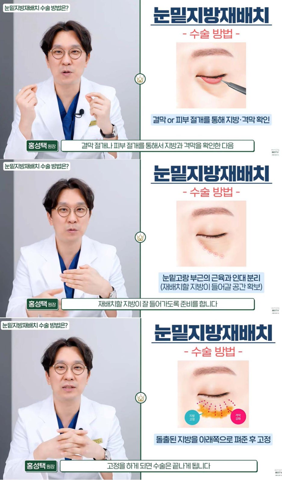 중년눈밑지방재배치수술 다크서클 개선할 수 있는 경우 관련 이미지 9