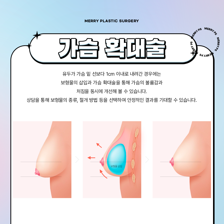 유방하수 교정수술 출산 후 처진 가슴 고민이라면 관련 이미지 4