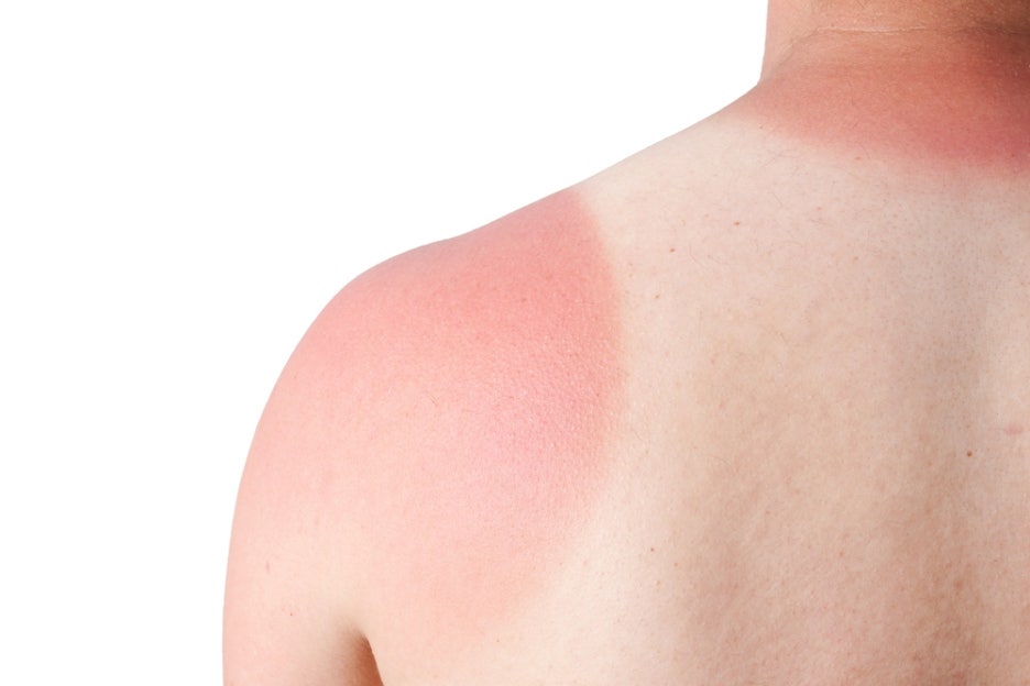 Summer Skin Conditions: How Can They Be Prevented and Treated? image 2